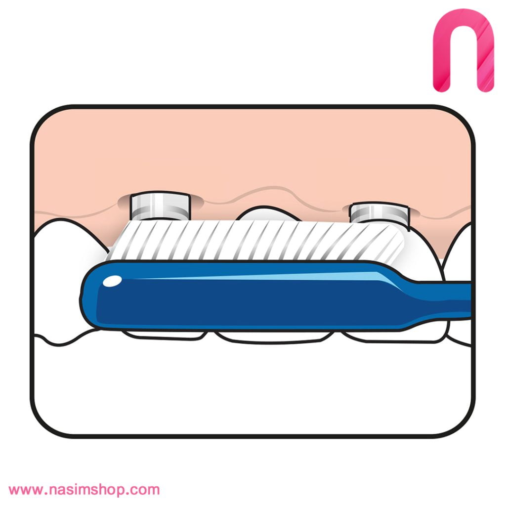 مسواک مدل Implant Orthodontic تپه